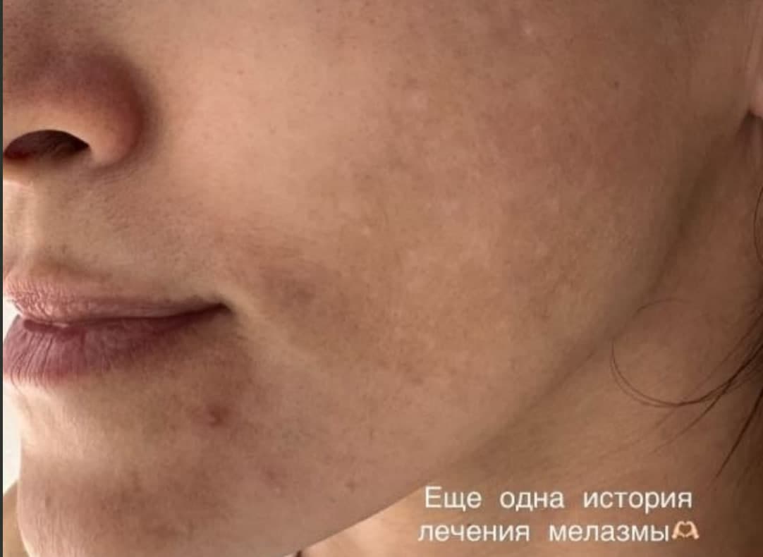 Мелазма — До
